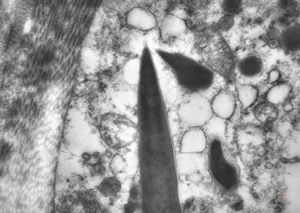 M, 43y. | myeloid leukemia … Auer bodies M, 43y. | myeloid leukemia … Auer bodies